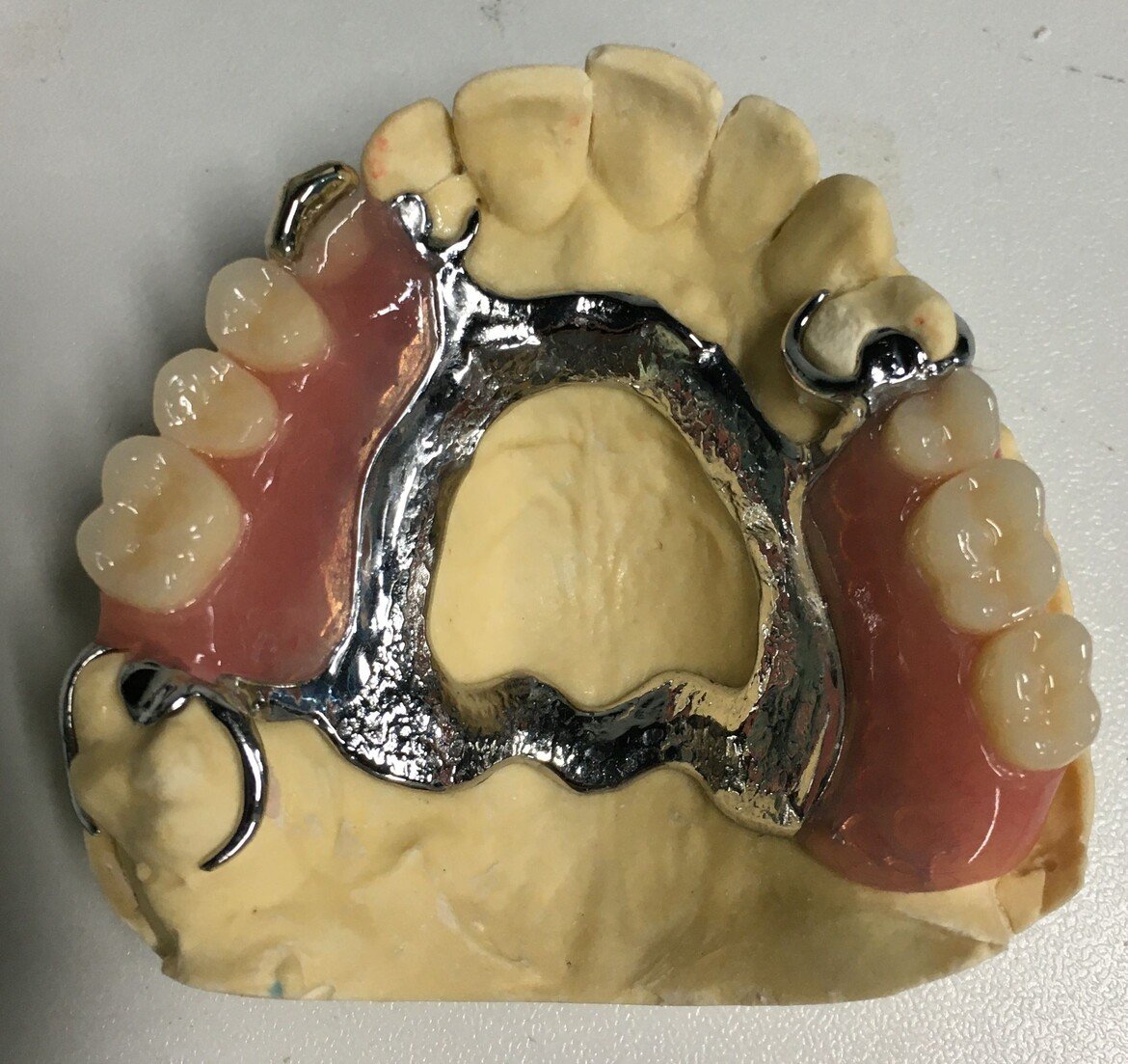 Cast Partial Denture treatment