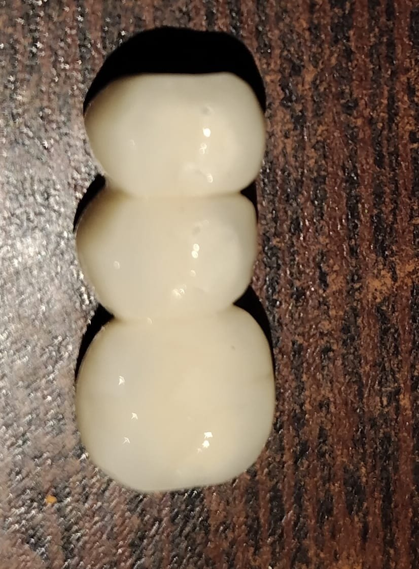 Crown and Bridge treatment