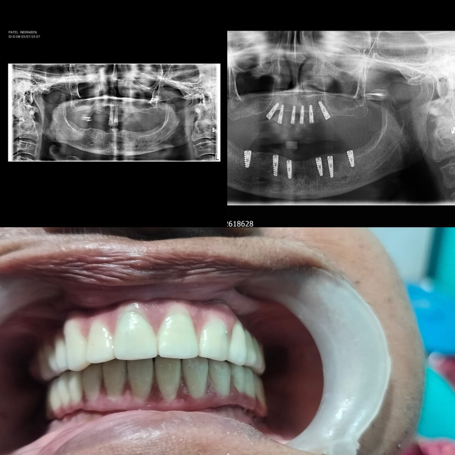 Dental Implants treatment