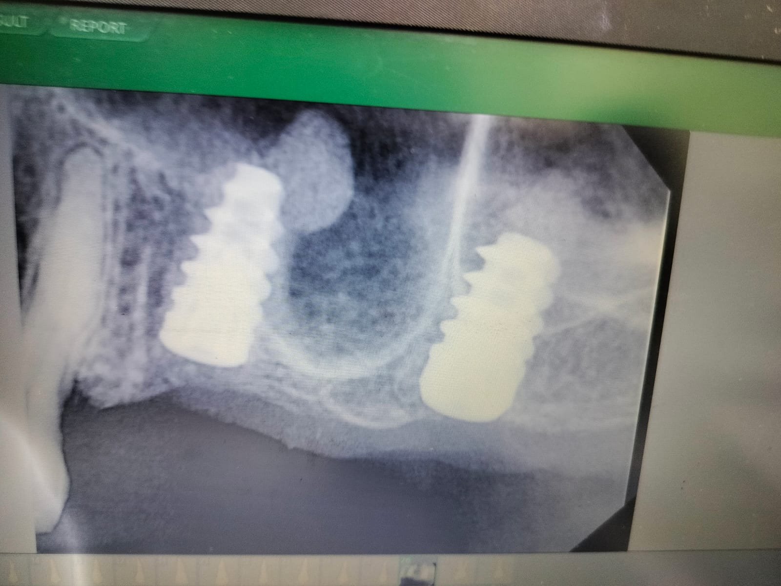 Dental Implants photo 2