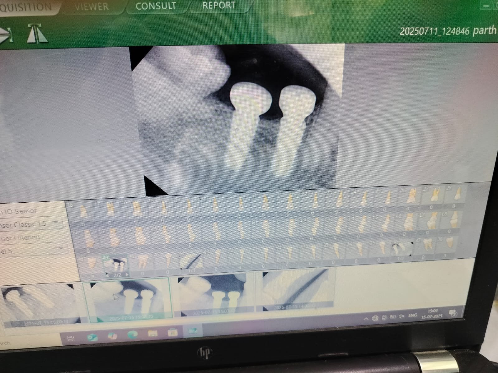 Dental Implants photo 3