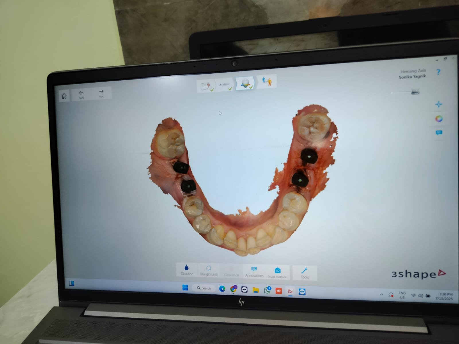 Dental Implants photo 4
