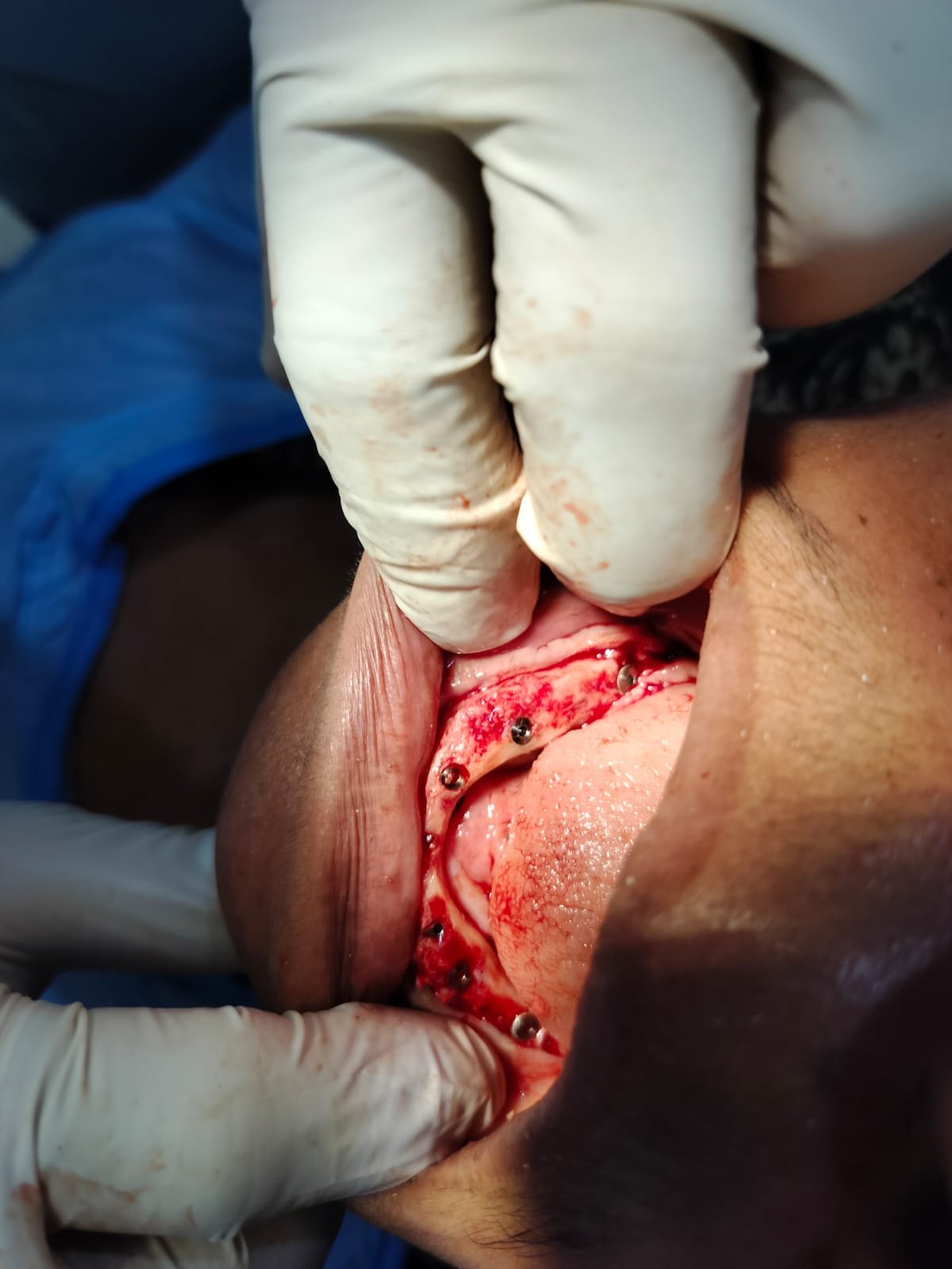 Dental Implants photo 5
