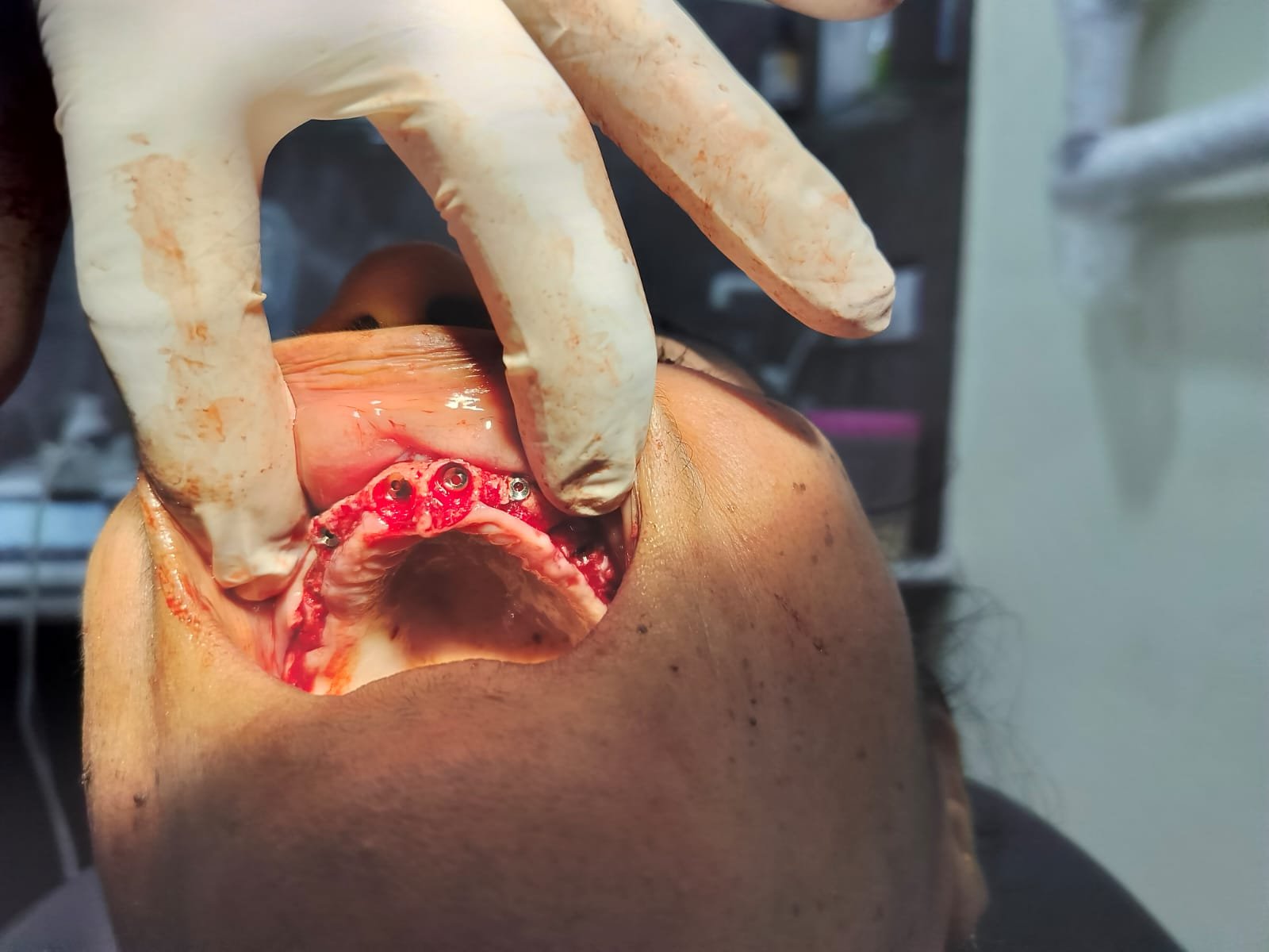 Dental Implants photo 6
