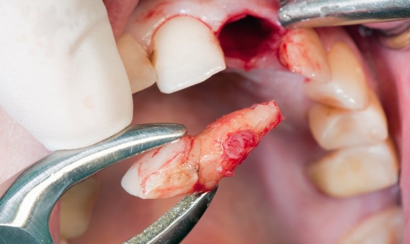 Extraction and Impaction treatment