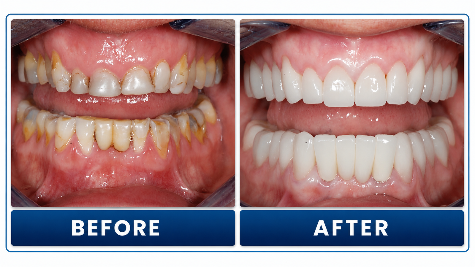 Full Mouth Rehabilitation treatment