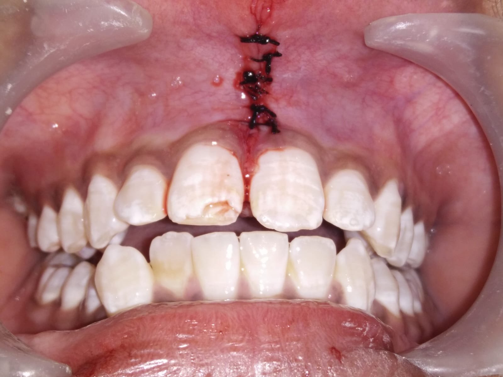 Gum Care and Flap Surgery treatment