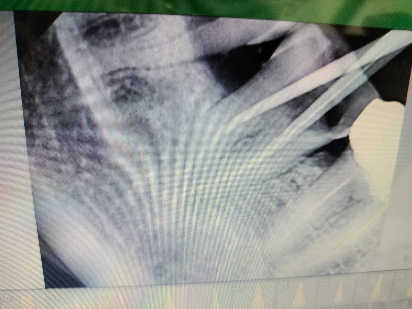 Root Canal Treatment treatment