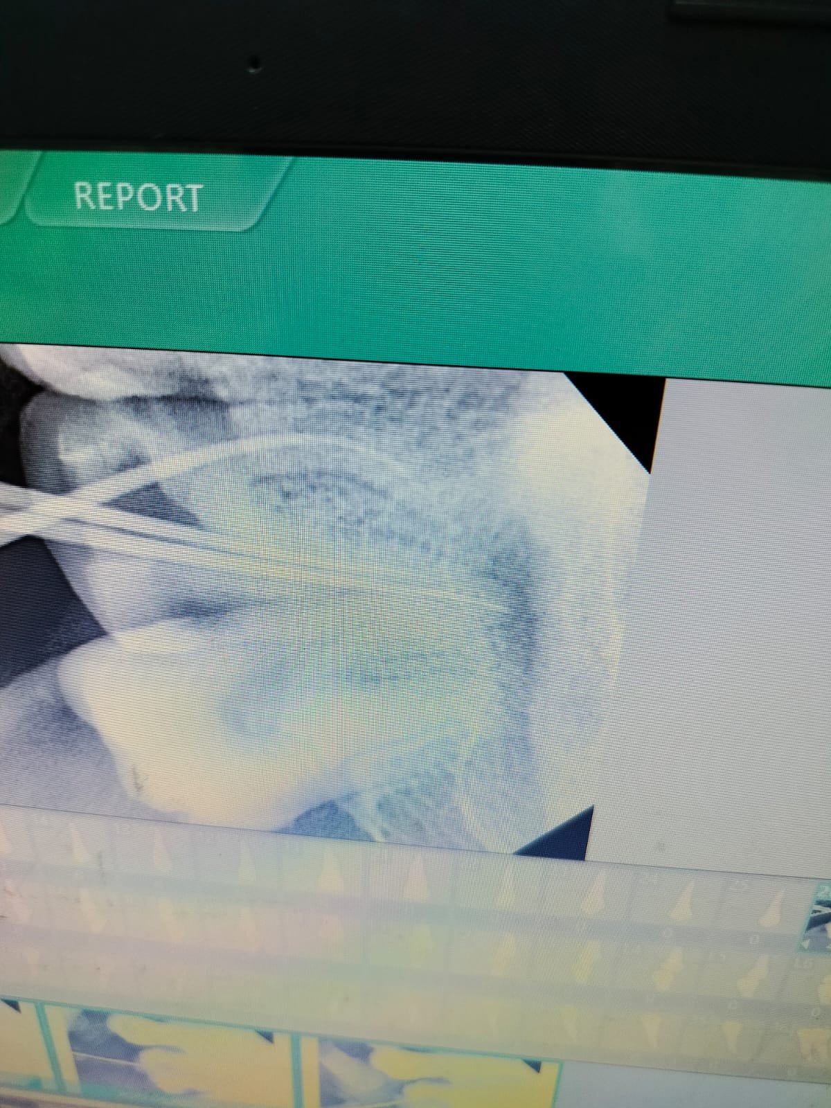 Root Canal Treatment photo 2