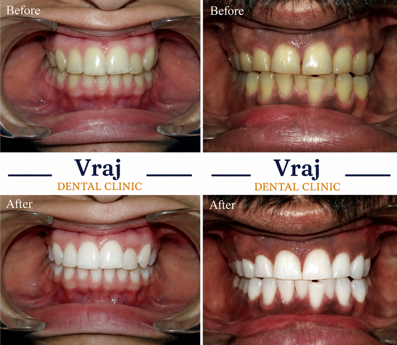 Bleaching and Teeth Whitening treatment